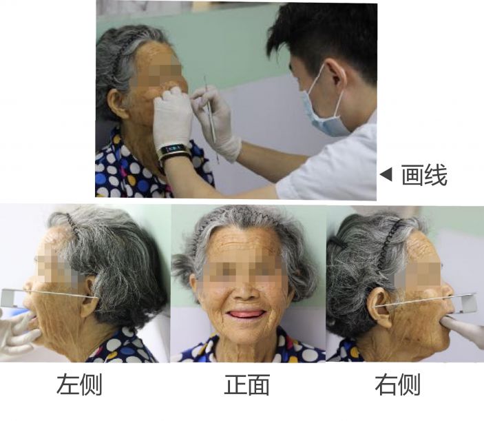 78歲老阿姨戴上新義牙，笑容滿分！